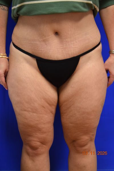Liposuction