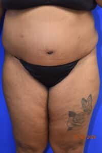 Body Procedures