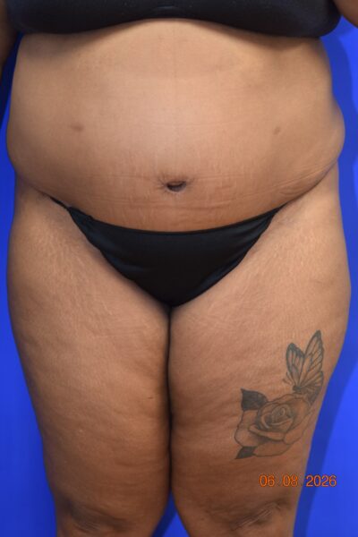 Body Procedures