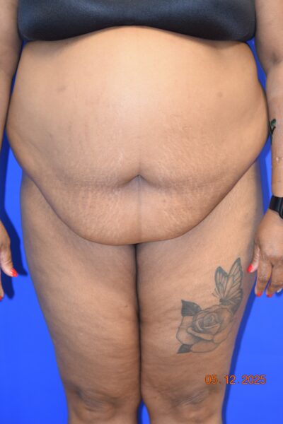 Body Procedures