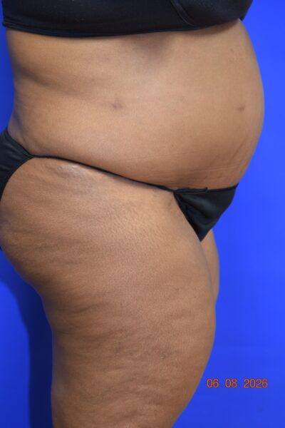 Body Procedures