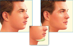 Chin Implants Mobile Alabama