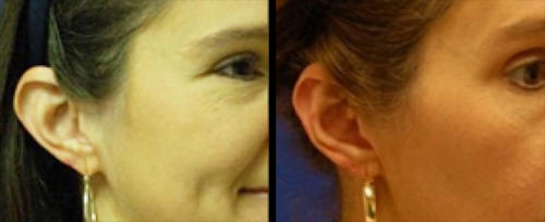 ear_surgery_Mobile_Alabama - Ear Pinning Surgery