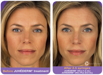 juvederm-before-after-1