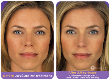 juvederm-before-after-1