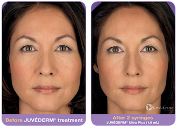 juvederm-before-after-2