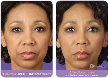 juvederm-before-after-3