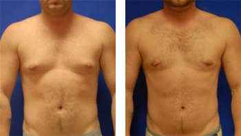 Gynecomastia Male Breast Reduction Results Mobile Alabama