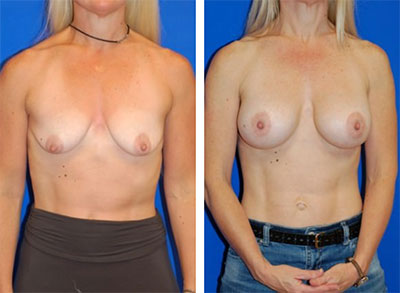 breast-augmentation-mobile-al