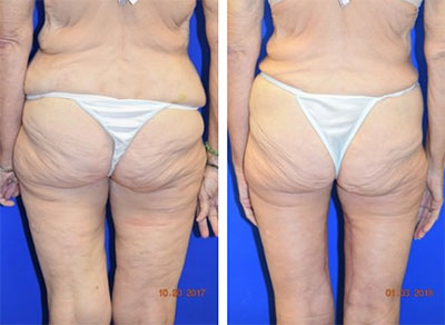 thighlift Results mobile-al