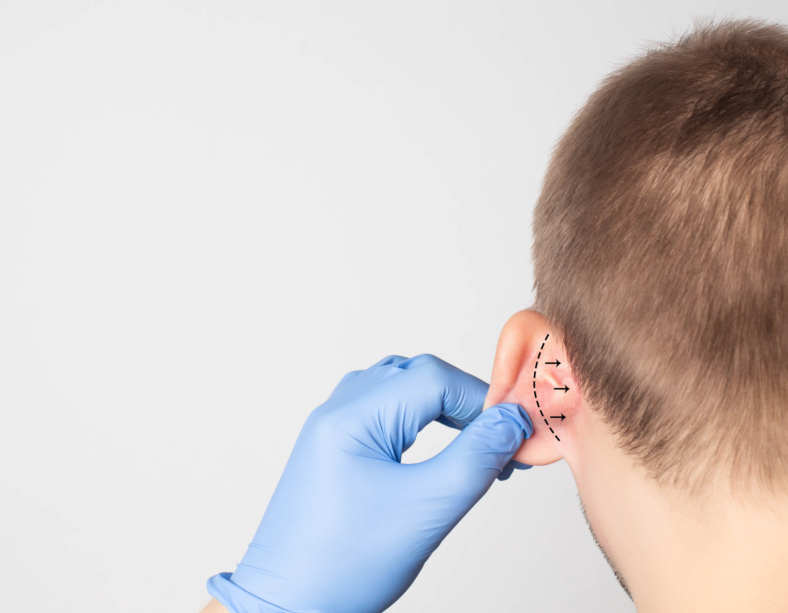 A plastic surgeon doctor examines a male patient s ear for an otoplasty operation - Ear Pinning Surgery